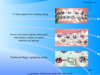 143
S. Jay Bowman. The Butterfly System. JCO 2004: 274-87
U-Turn square-wire rotating spring
Power Arm limits tipping when used
with elastics, chains, or nickel
titanium coil springs
Traditional Begg’s uprighting spring
The Butterfly system…
 