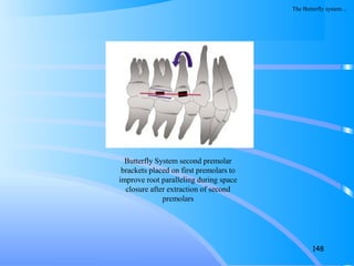 148
Butterfly System second premolar
brackets placed on first premolars to
improve root paralleling during space
closure after extraction of second
premolars
The Butterfly system…
 