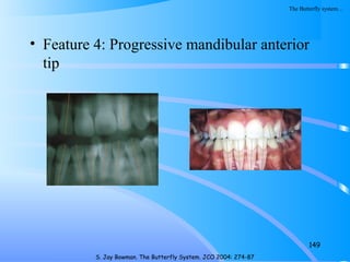 • Feature 4: Progressive mandibular anterior
tip
149
S. Jay Bowman. The Butterfly System. JCO 2004: 274-87
The Butterfly system…
 