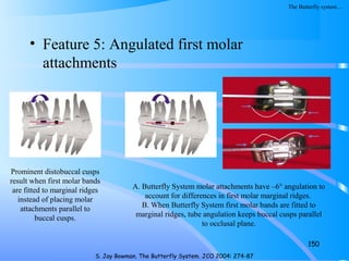 • Feature 5: Angulated first molar
attachments
150
S. Jay Bowman. The Butterfly System. JCO 2004: 274-87
The Butterfly system…
Prominent distobuccal cusps
result when first molar bands
are fitted to marginal ridges
instead of placing molar
attachments parallel to
buccal cusps.
A. Butterfly System molar attachments have –6° angulation to
account for differences in first molar marginal ridges.
B. When Butterfly System first molar bands are fitted to
marginal ridges, tube angulation keeps buccal cusps parallel
to occlusal plane.
 