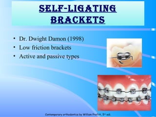 SeLf-LiGATiNG
bRAckeTS
• Dr. Dwight Damon (1998)
• Low friction brackets
• Active and passive types
159
Contemporary orthodontics by William Profitt, 5th
edi.
 