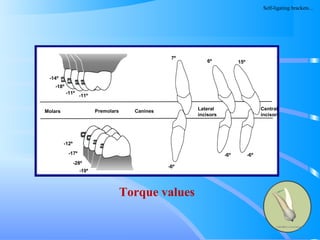 161
Molars Premolars Canines Lateral
incisors
Central
incisors
-6º
-6º-6º
-12º
-17º
-28º
-10º
-14º
-18º
-11º
-11º
7º
6º 15º
Torque values
Self-ligating brackets…
 