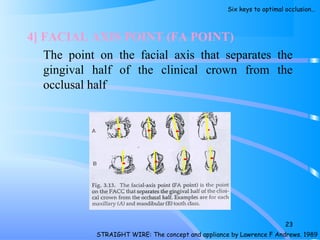 4] FACIAL AXIS POINT (FA POINT)
The point on the facial axis that separates the
gingival half of the clinical crown from the
occlusal half
23
STRAIGHT WIRE: The concept and appliance by Lawrence F Andrews. 1989
Six keys to optimal occlusion…
 