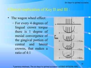 Clinical implication of Key II and III :
• The wagon wheel effect:
– For every 4 degrees of
lingual crown torque
there is 1 degree of
mesial convergence of
the gingival portion of
central and lateral
crowns, that makes a
ratio of 4:1
31
*Lawrence Andrews, The six keys to optimal occlusion. AJODO 1972(296-309)
Six keys to optimal occlusion…
 