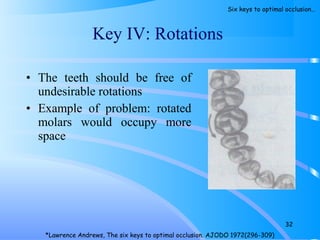 • The teeth should be free of
undesirable rotations
• Example of problem: rotated
molars would occupy more
space
Key IV: Rotations
32
*Lawrence Andrews, The six keys to optimal occlusion. AJODO 1972(296-309)
Six keys to optimal occlusion…
 