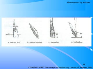38
STRAIGHT WIRE: The concept and appliance by Lawrence F Andrews. 1989
Measurements by Andrews…
 