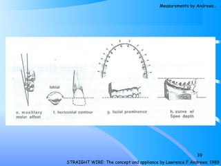 39
STRAIGHT WIRE: The concept and appliance by Lawrence F Andrews. 1989
Measurements by Andrews…
 