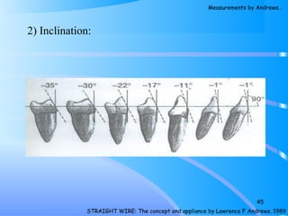 2) Inclination:
45
STRAIGHT WIRE: The concept and appliance by Lawrence F Andrews. 1989
Measurements by Andrews…
 