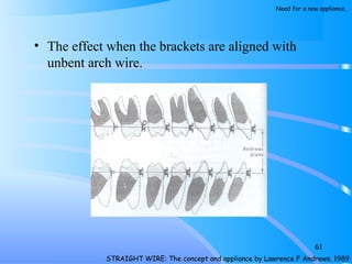 • The effect when the brackets are aligned with
unbent arch wire.
61
STRAIGHT WIRE: The concept and appliance by Lawrence F Andrews. 1989
Need for a new appliance…
 