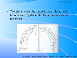 • Therefore when the brackets are placed they
become as irregular in the facial prominence as
the crown
69
STRAIGHT WIRE: The concept and appliance by Lawrence F Andrews. 1989
Need for a new appliance…
 