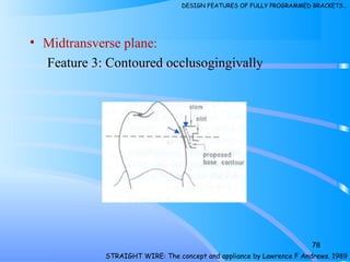 • Midtransverse plane:
Feature 3: Contoured occlusogingivally
78
STRAIGHT WIRE: The concept and appliance by Lawrence F Andrews. 1989
DESIGN FEATURES OF FULLY PROGRAMMED BRACKETS…
 