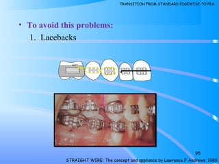 • To avoid this problems:
1. Lacebacks
95
1
STRAIGHT WIRE: The concept and appliance by Lawrence F Andrews. 1989
TRANSITION FROM STANDARD EDGEWISE TO PEA…
 