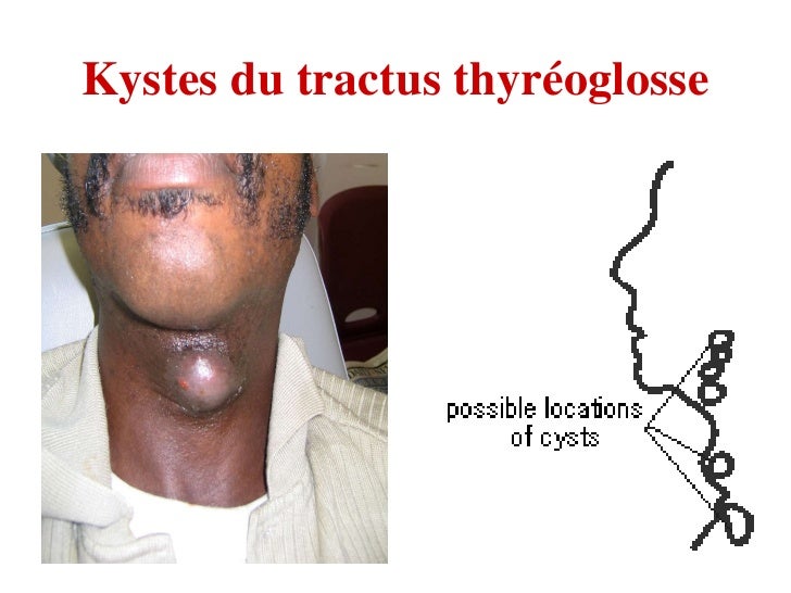 Kyste Du Tractus Thyréoglosse Chez L Adulte