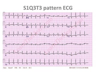 S1Q3T3 pattern ECG
 