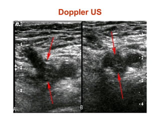 Doppler US
 