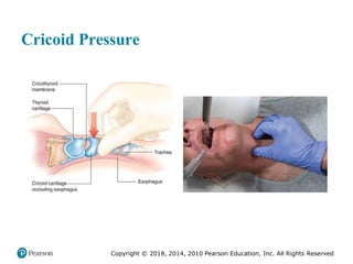 Pec11 chap 10   airway, ventilation, oxygenation