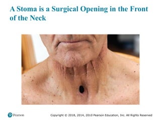 Pec11 chap 10   airway, ventilation, oxygenation
