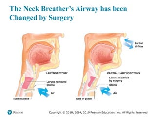 Pec11 chap 10   airway, ventilation, oxygenation