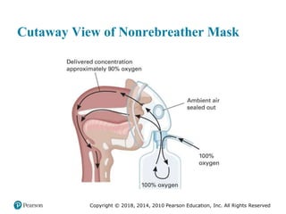 Pec11 chap 10   airway, ventilation, oxygenation