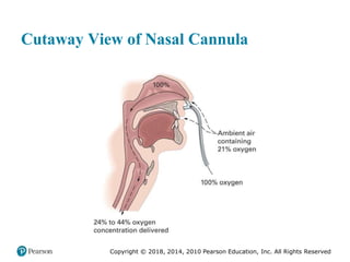 Pec11 chap 10   airway, ventilation, oxygenation