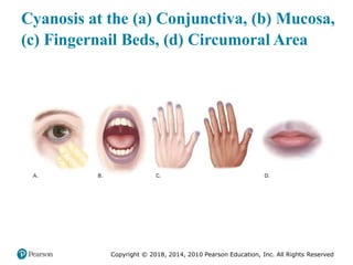 Pec11 chap 10   airway, ventilation, oxygenation