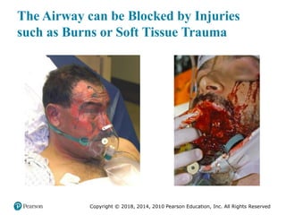 Pec11 chap 10   airway, ventilation, oxygenation