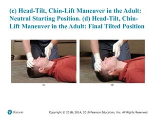 Pec11 chap 10   airway, ventilation, oxygenation