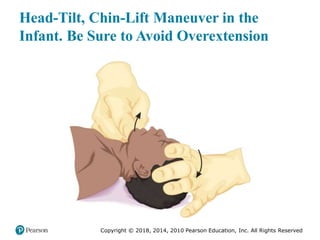 Pec11 chap 10   airway, ventilation, oxygenation