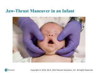 Pec11 chap 10   airway, ventilation, oxygenation