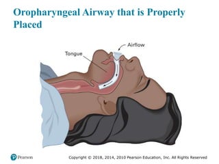 Pec11 chap 10   airway, ventilation, oxygenation