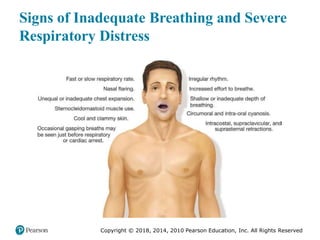 Pec11 chap 10   airway, ventilation, oxygenation
