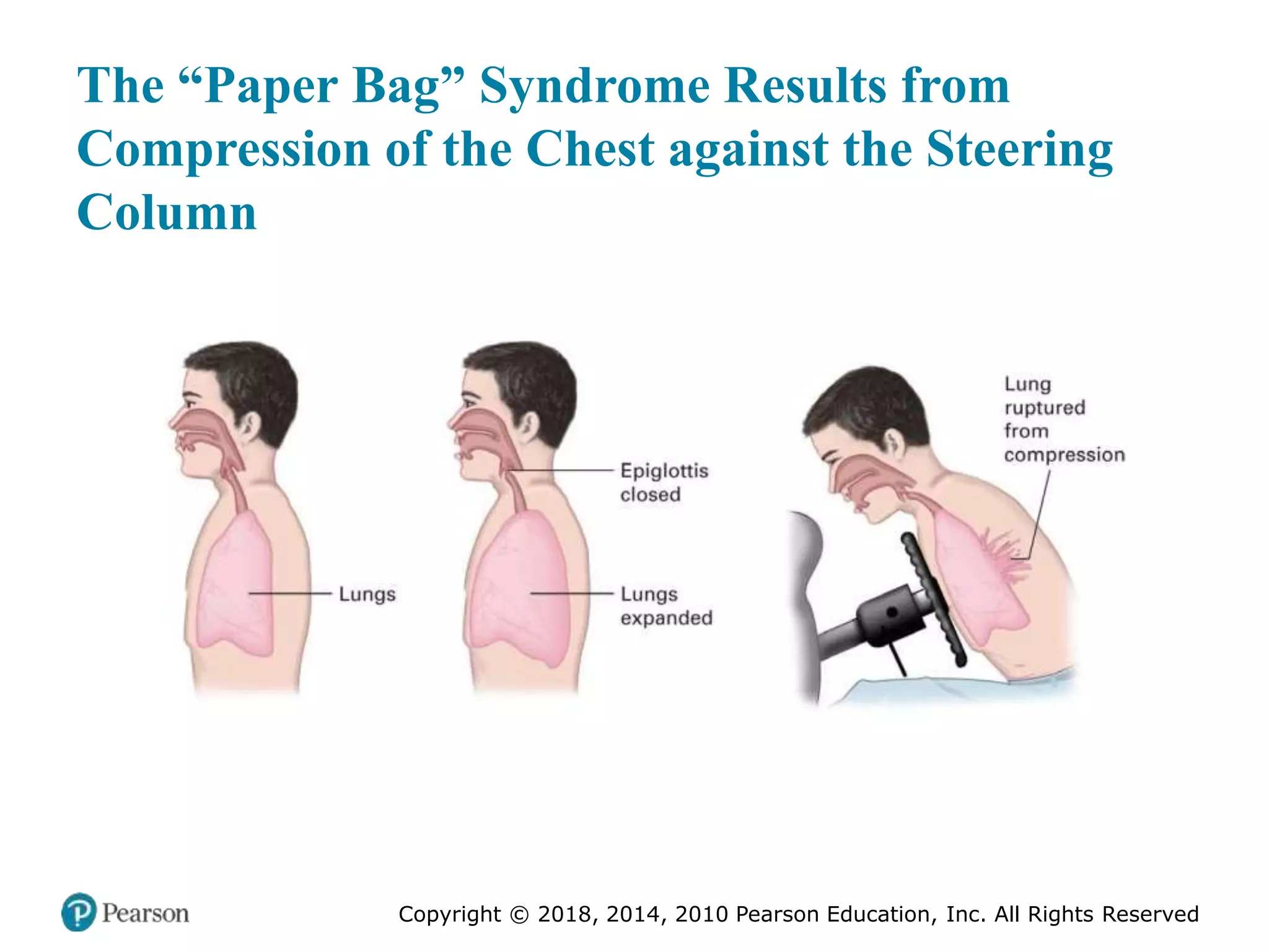 Pec11 chap 27 trauma overview