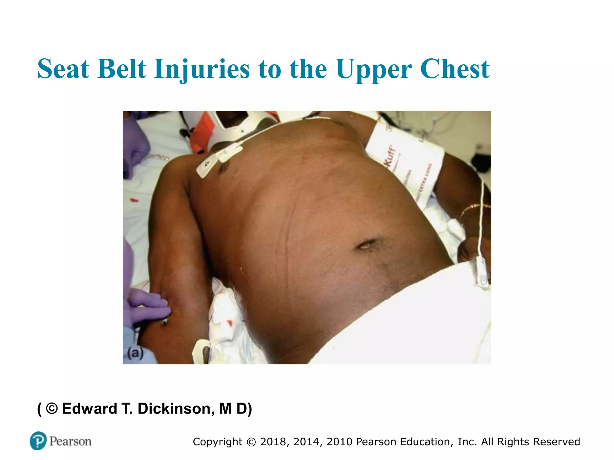 Pec11 chap 27 trauma overview