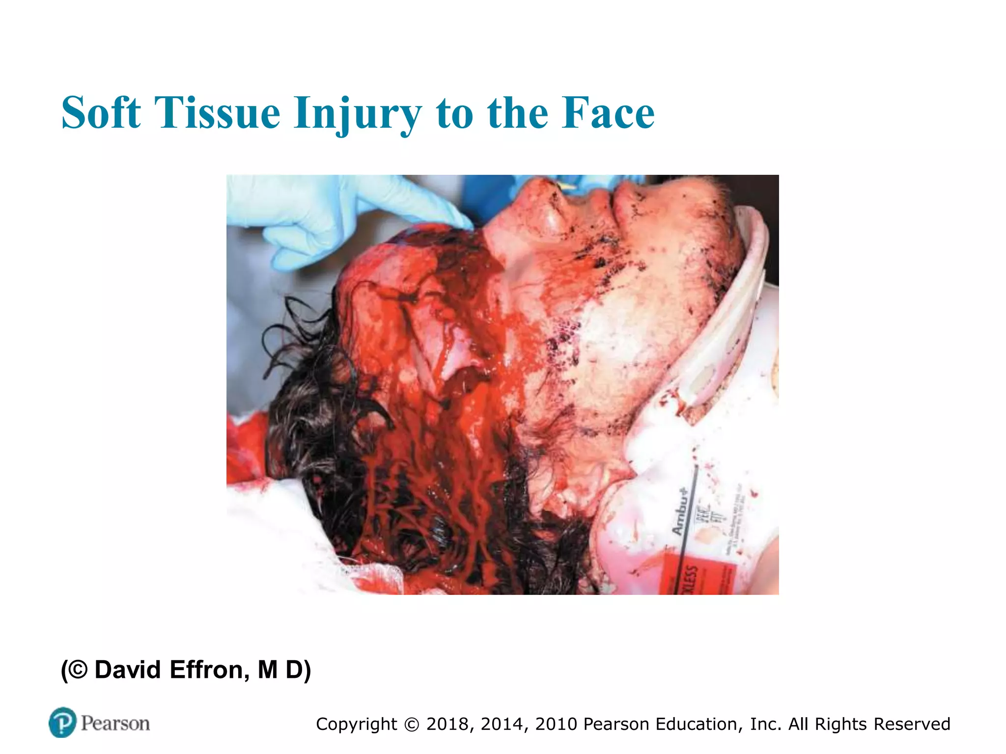 Pec11 chap 27 trauma overview