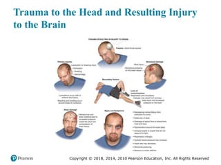 Pec11 chap 31 head trauma