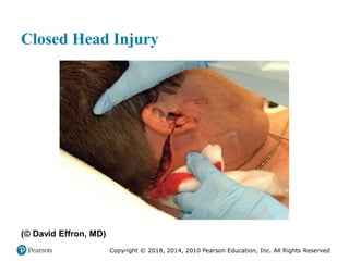 Pec11 chap 31 head trauma