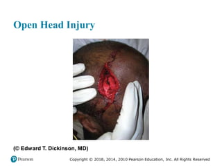 Pec11 chap 31 head trauma