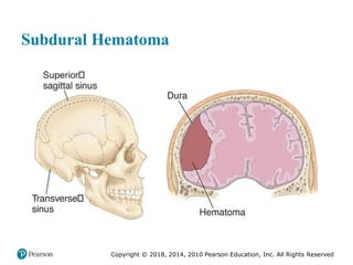 Pec11 chap 31 head trauma