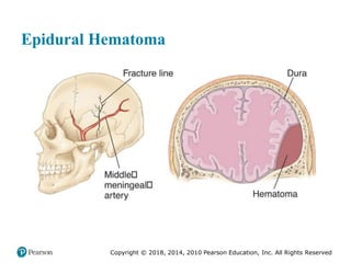 Pec11 chap 31 head trauma