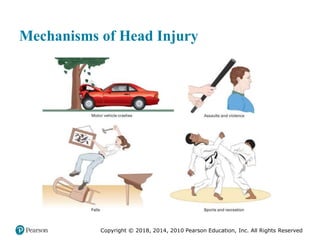 Pec11 chap 31 head trauma