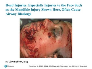 Pec11 chap 31 head trauma