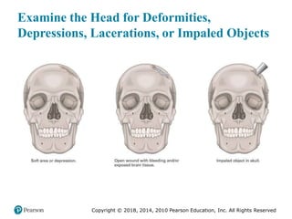 Pec11 chap 31 head trauma