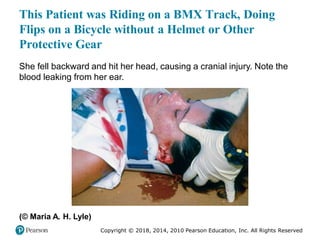 Pec11 chap 31 head trauma