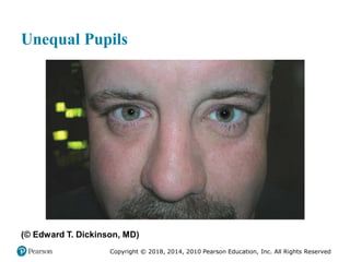Pec11 chap 31 head trauma