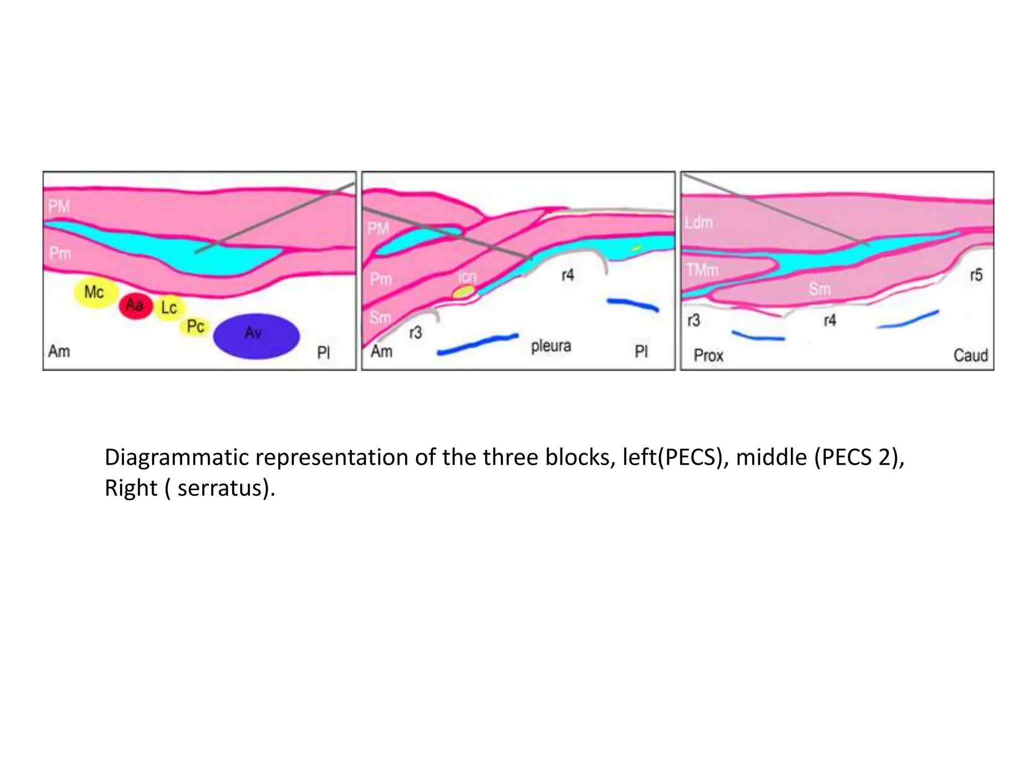 Pec I and PECS II, serratus anterior block | PPTX