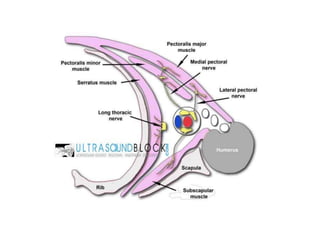 Interpectoral Block Pec I and PECS II, serratus anterior block | PPTX