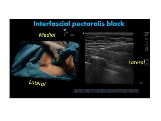 SERRATUS PLANE BLOCK
• Nerve blocked: thoracodorsal , thoracic intercostal nerves. Lateral part of
the thorax is blocked.
...