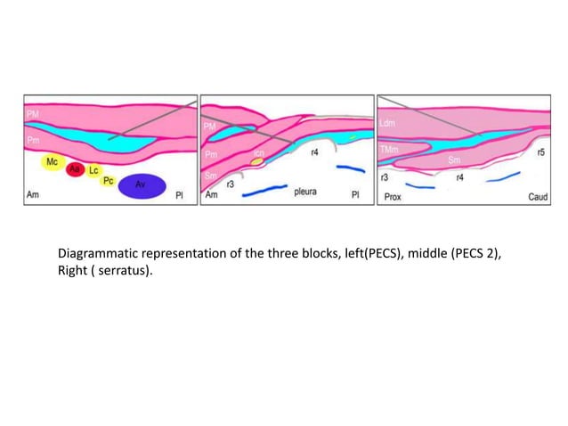 Pec I and PECS II, serratus anterior block