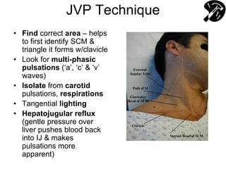JVP Technique
• Find correct area – helps
to first identify SCM &
triangle it forms w/clavicle
• Look for multi-phasic
pulsations (‘a’, ‘c’ & ‘v’
waves)
• Isolate from carotid
pulsations, respirations
• Tangential lighting
• Hepatojugular reflux
(gentle pressure over
liver pushes blood back
into IJ & makes
pulsations more
apparent)
 