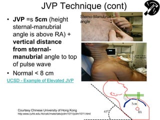 JVP Technique (cont)
• JVP =s 5cm (height
sternal-manubrial
angle is above RA) +
vertical distance
from sternal-
manubrial angle to top
of pulse wave
• Normal < 8 cm
UCSD - Example of Elevated JVP
Sterno-Manubrial
angle
Courtesy Chinese University of Hong Kong
http:www.cuhk.edu.hk/cslc/materials/pclm1011/pclm1011.html
 